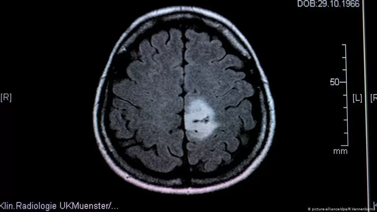 گلیوبلاصطومه تومورنڭ بویومسی أولطراصونله جانلی ایزلەنلندی – Glioblastoma tümörünün büyümesi ultrasonla canlı izlendi